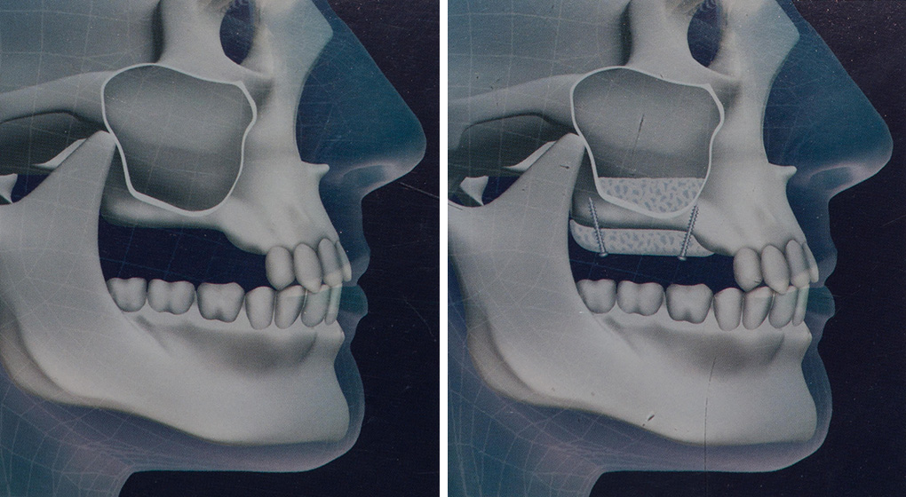 Восстановление костной ткани зубов. Синус пластика верхней челюсти. Остеопластика костной ткани челюстей. Костная пластика верхней челюсти.