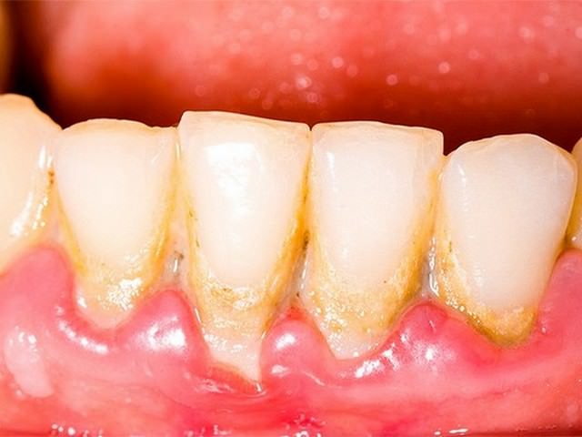 Что делать, если после отбеливания или чистки от камня ультразвуком болят зубы, и повысилась их чувствительность