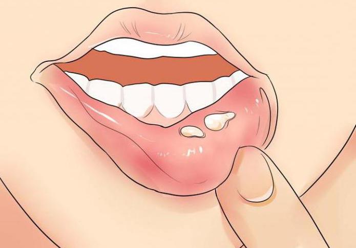 герпес на губах причины появления и лечение