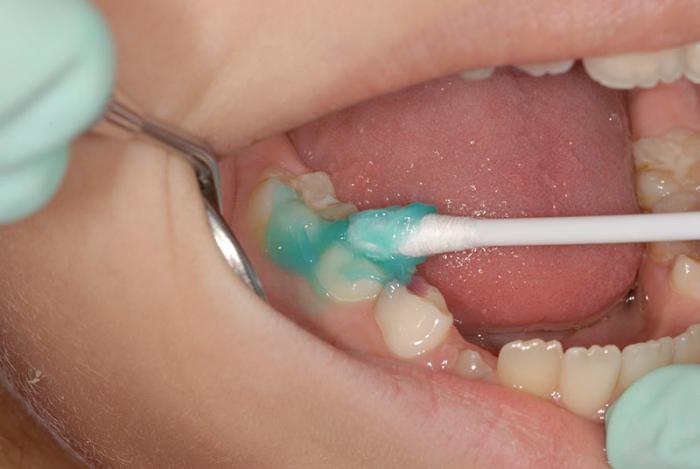 реминерализация зубов препараты