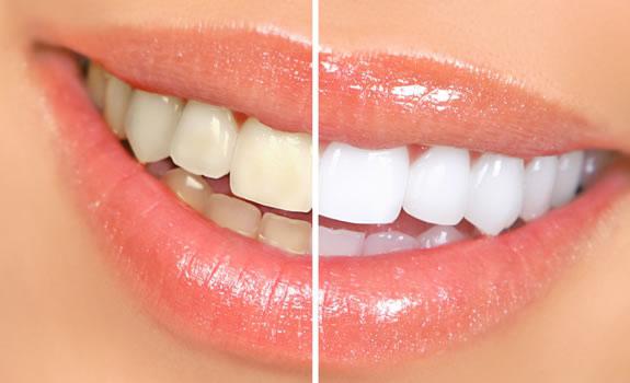 реминерализация эмали зубов
