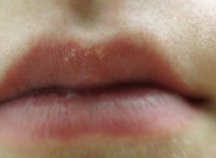 на внутренней стороне губы белое пятно