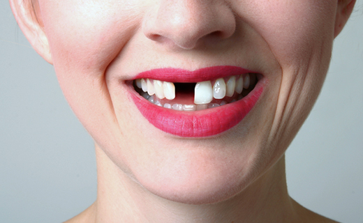Показания для имплантации - отсутствие зуба