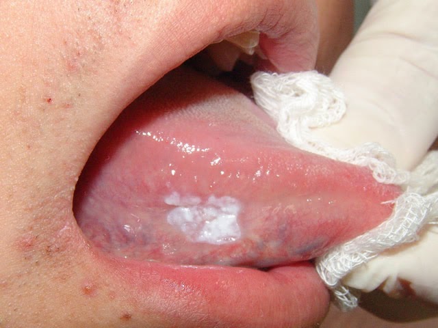 врач осматривает пациента с белыми пятнами на языке