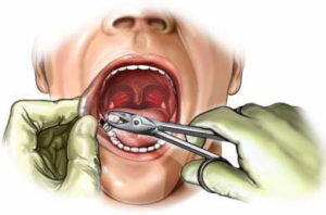 Работа стоматолога по удалению зуба