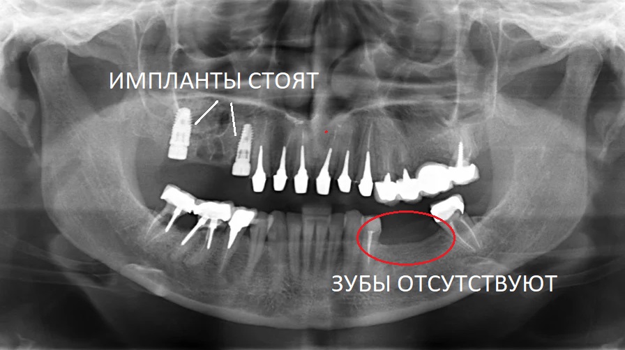 Перегруз в областях установленных имплантов и отсутствующих зубов