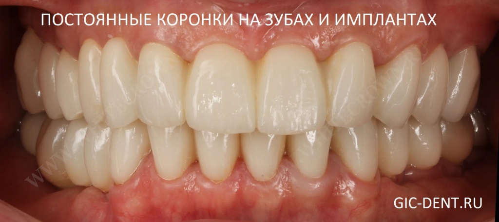 На зубы и импланты установлены постоянные коронки. Этап постоянного протезирования.