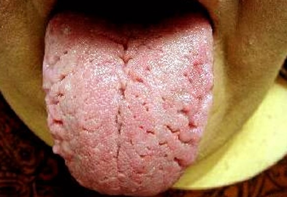 cracked tongue pictures
