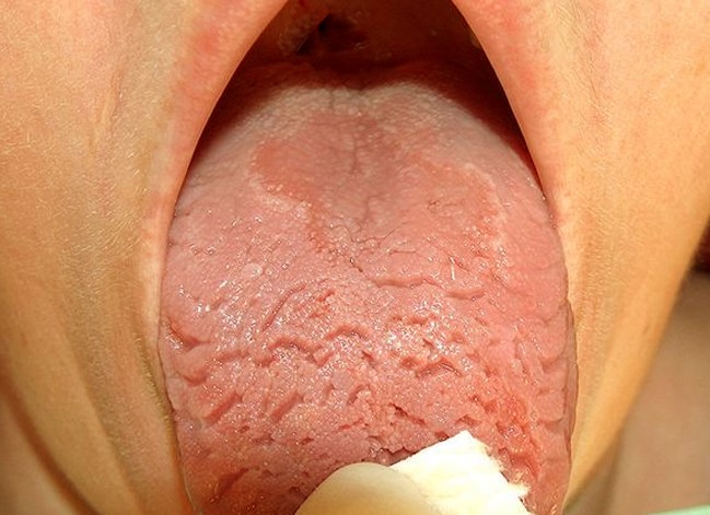 cracked tongue