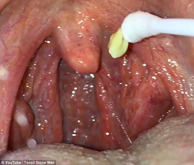 This video shows the revolting moment a man pushes hardened lumps of yellow pus out of his tonsils. Tonsil stones are clumps of calcified food, mucus and dead cells which become trapped in the organ