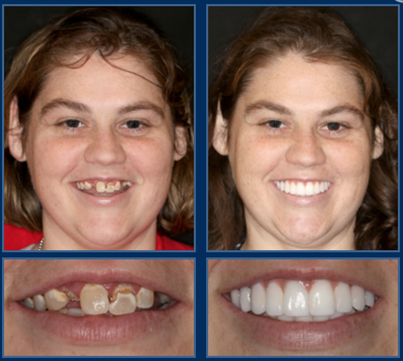Можно поставить. Исправление кривых зубов винирами. Брекеты передние зубы до и после.