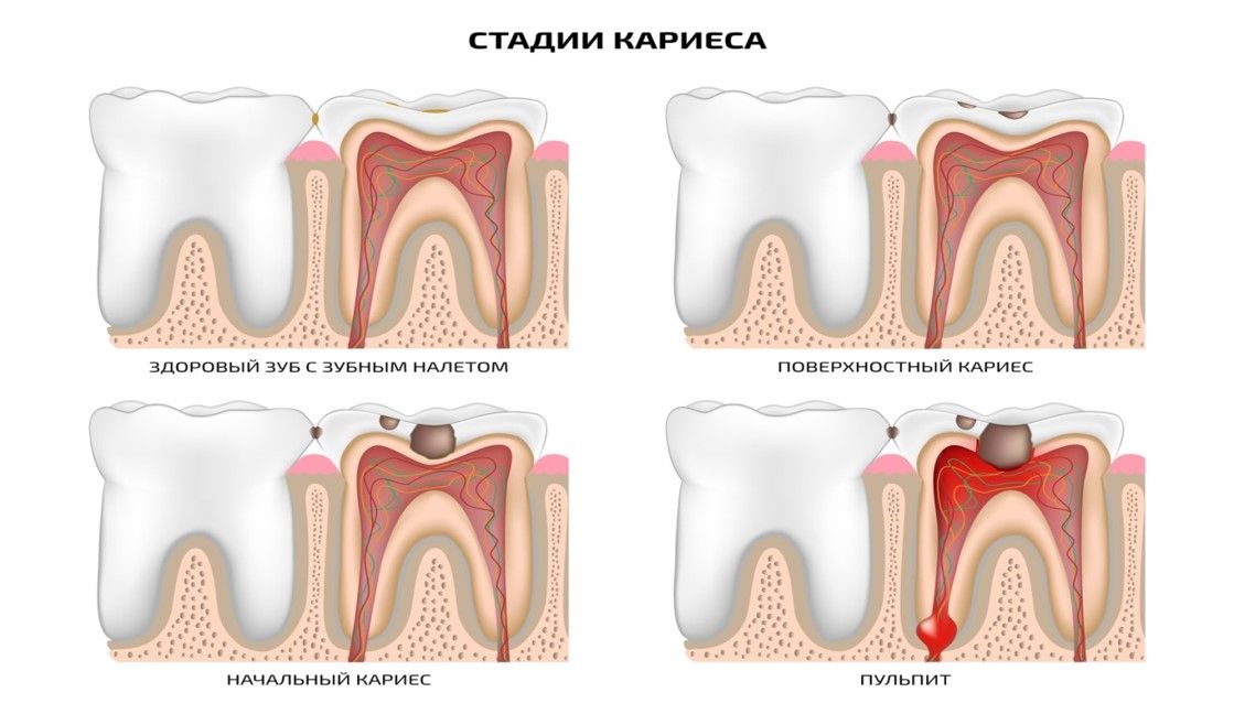 Периодонтит и пульпит разница. Симптомы кариеса и пульпита. Пришеечный кариес молочного зуба. Пульпит фронтальных зубов.