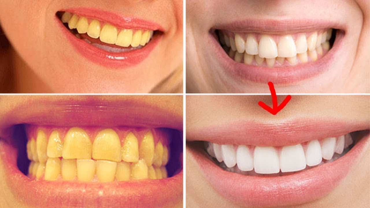 Отбеливание зубов содой фото до и после