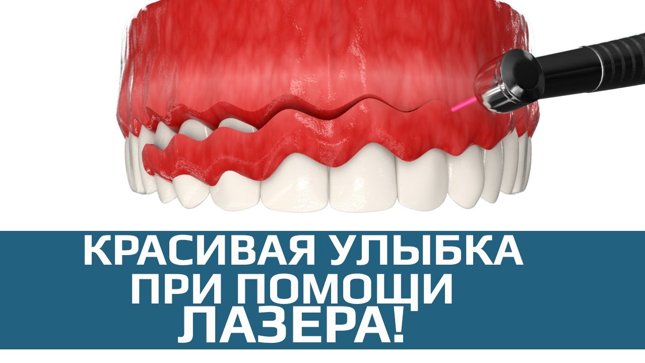 Лазерное десен. Лазер стоматологический для гингивэктомии. Гингивэктомия стоматология что это. Лазер в хирургической стоматологии.