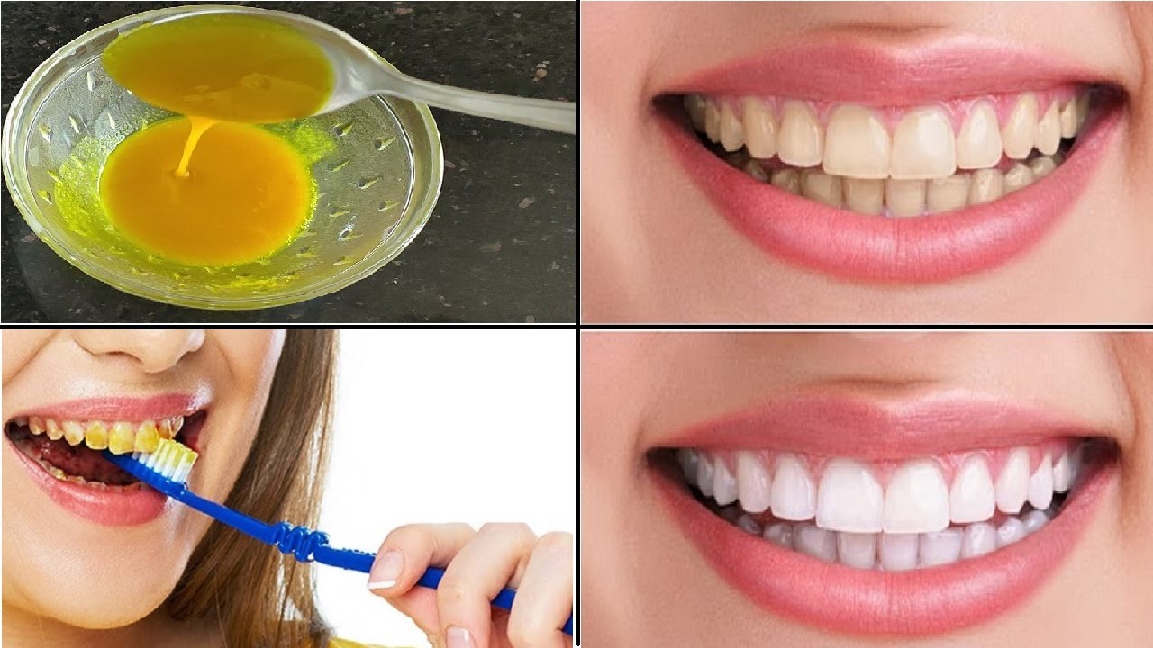 Как можно отбелить зубы в домашних условиях. Отбеливание зубов. Отбеливание зубов перекисью водорода. Перекись для отбеливания зубов до и после. Отбеливание зубов до и после.