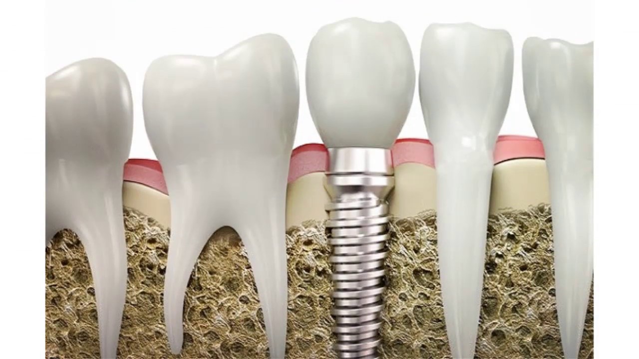 Можно ли кормить имплантами. Остеоинтеграция имплантата. Противопоказания к имплантации зубов. Импланты зубов противопоказания.