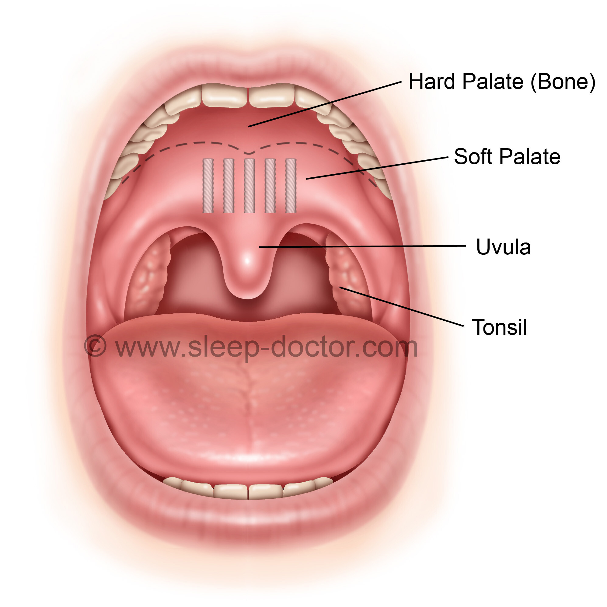 аденоиды фото во рту