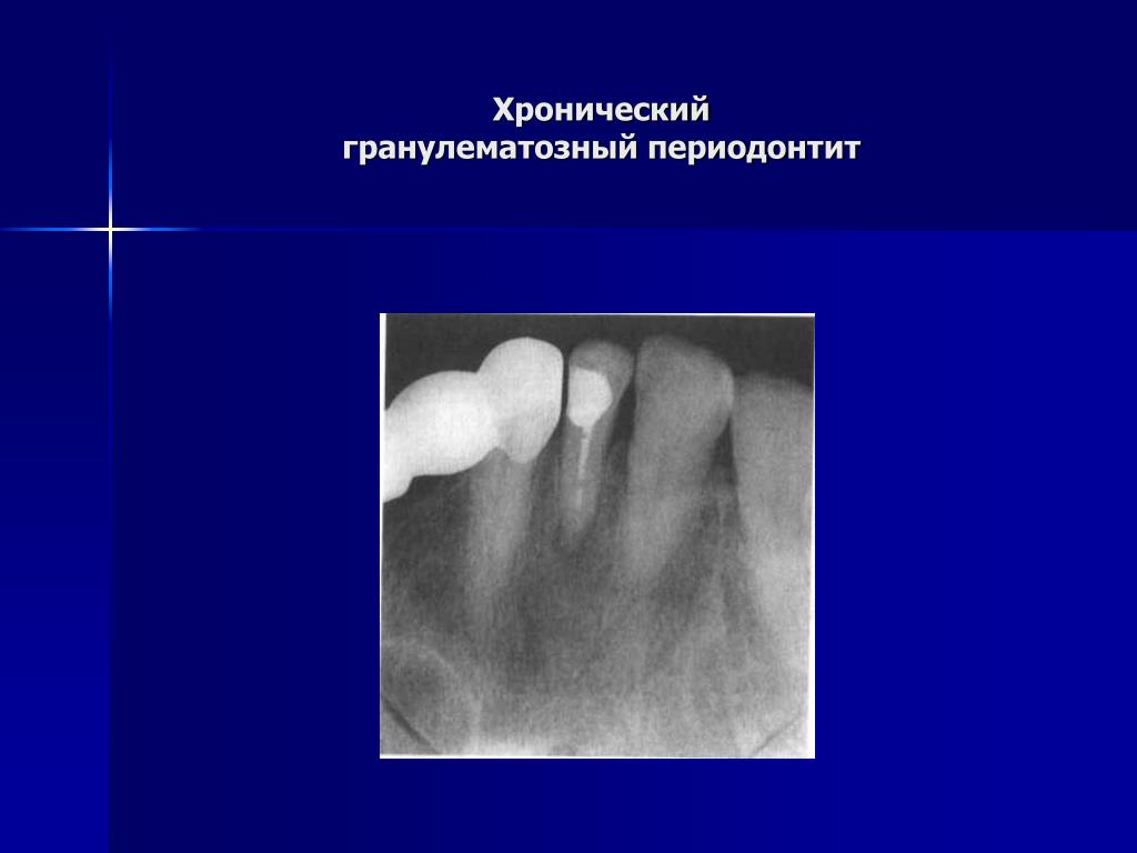 Хронический фиброзный периодонтит мкб. Гранулирующий периодонтит рентген. Гранулематозный апикальный периодонтит.