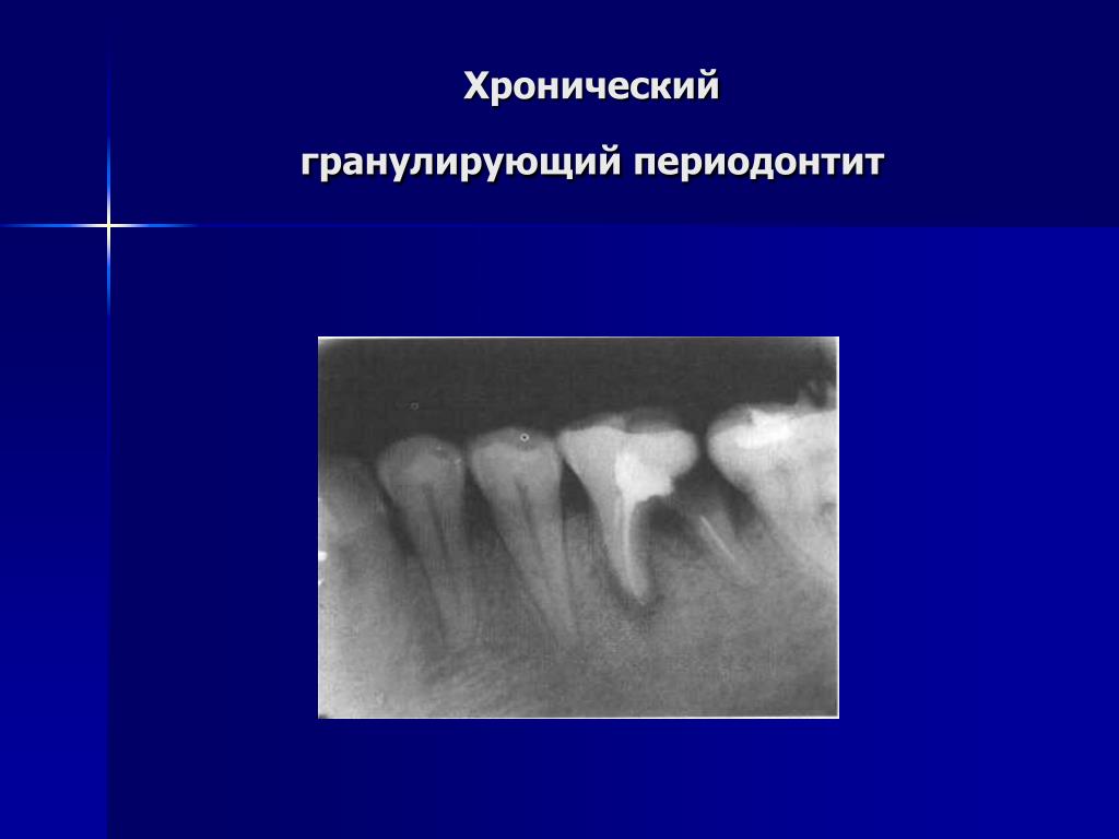 Хирургическое лечение периодонтитов презентация