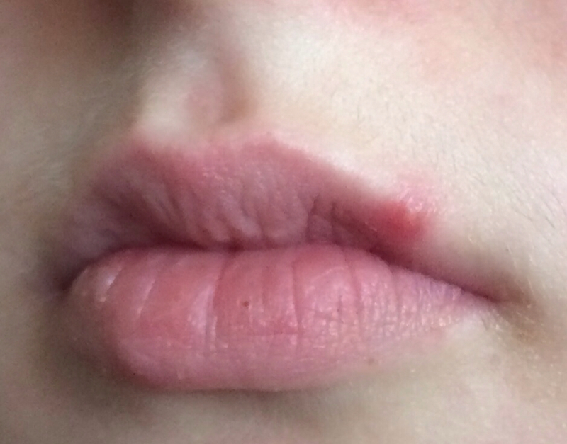 Пятно на губе: причины, симптомы и лечение 
