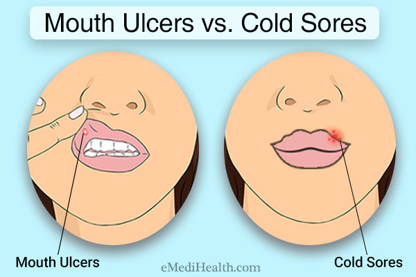 Difference between mouth ulcer and cold sores
