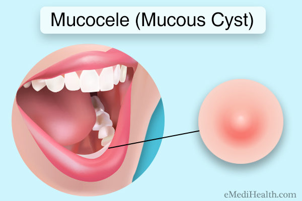 Mucocele (mucous cyst)