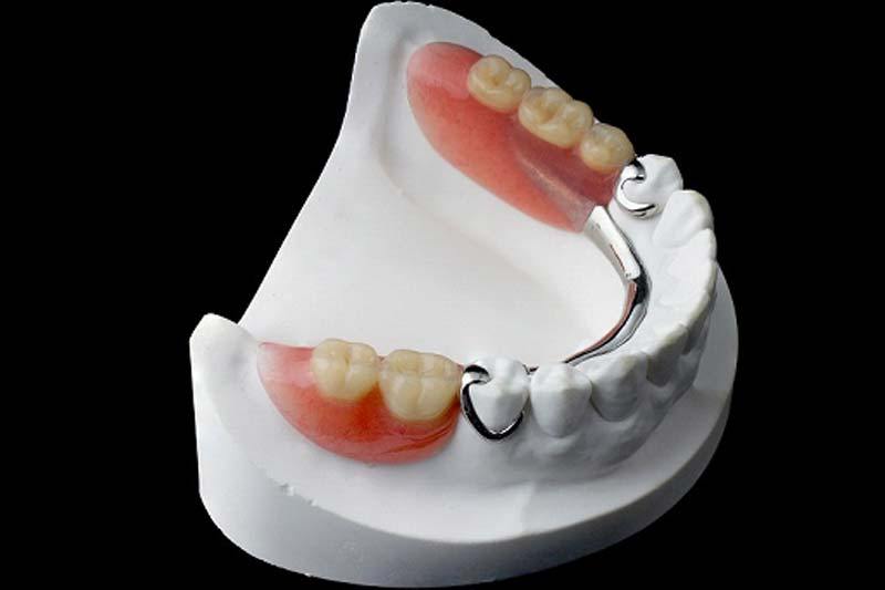 removable partial denture on a dental cast