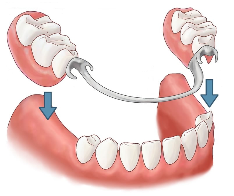 removable partial dentures