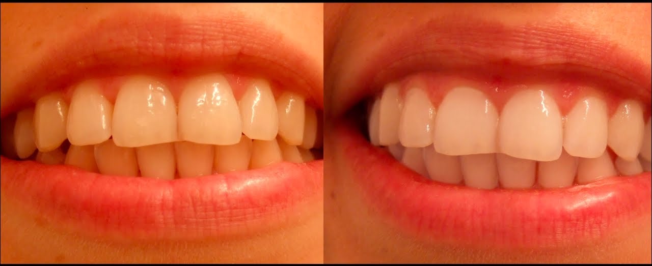 Чайное дерево для зубов, фото до и после процедур