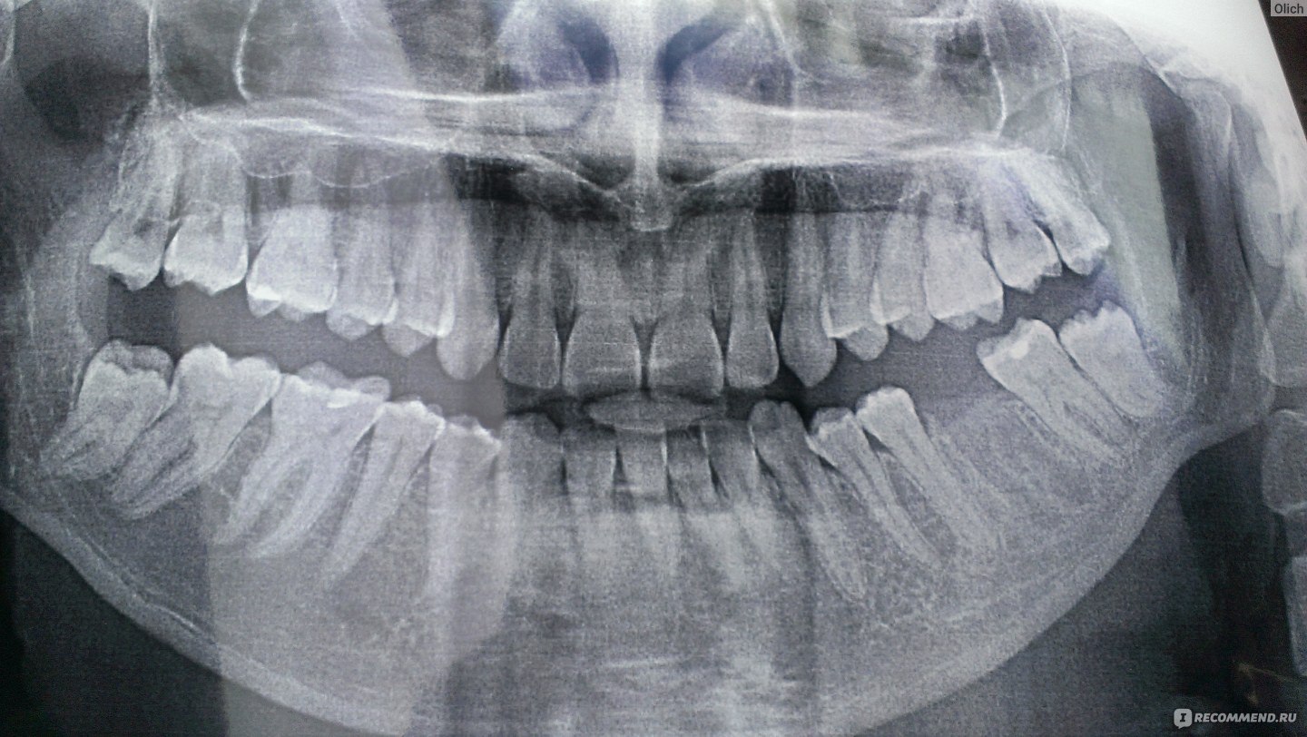 Ретинированный зуб это. Ретинированный шестой зуб. 6 Зубов мудрости на снимке.