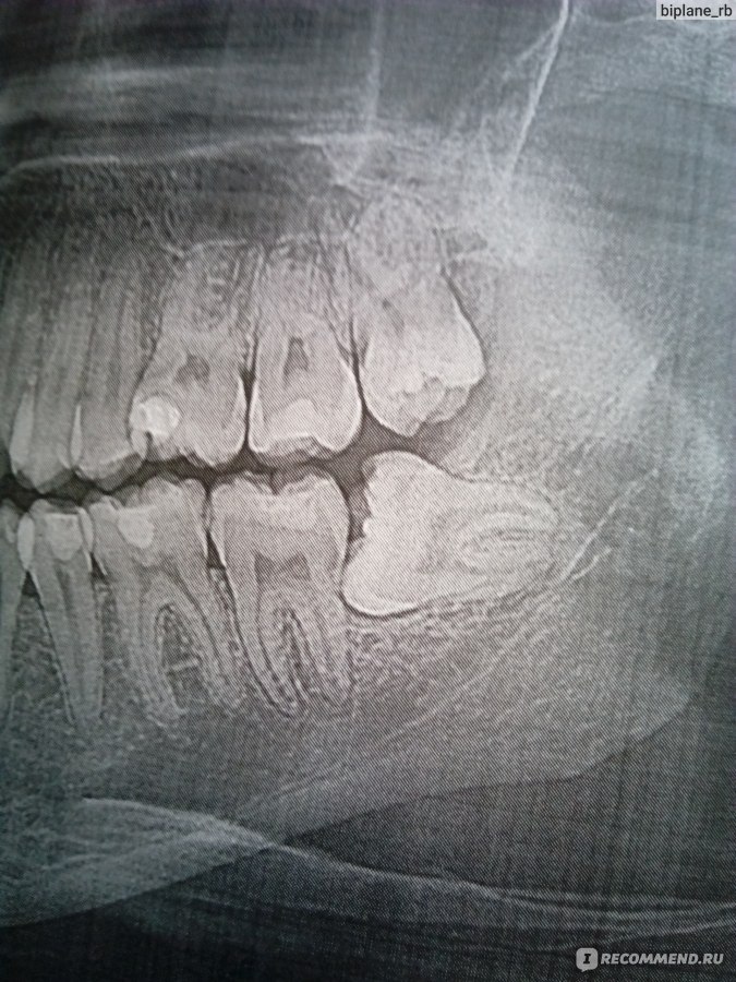 Зуб 8 корень. Ретинированный дистопированный зуб мудрости. Ретинированный зуб мудрости рентген. Дистопированный зуб мудрости рентген. Ретинированного дистопированного зуба.
