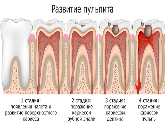 Пульпит трехкорневого зуба. Пульпит 1 канального зуба.