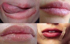 Почему сохнут губы у женщин