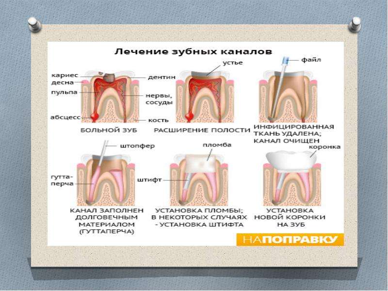 Почему болит зуб после пломбирования. Схема пломбирования зуба. Пломбирование корней временных зубов. Пломбирование зуба этапы. Постоянный метод пломбирование.