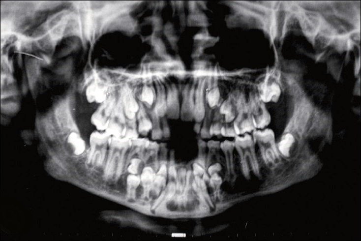 Рентген детских зубов с молочных фото