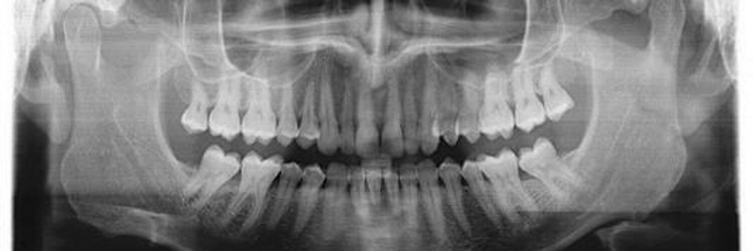 Панорамный снимок ребенка. Рентген челюсти взрослого. Вывих челюсти на панорамном снимке. Снимок зубов сбоку правильный прикус.