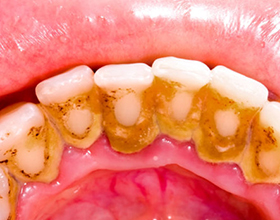 Нужно ли удалять зубной камень: нюансы и особенности
