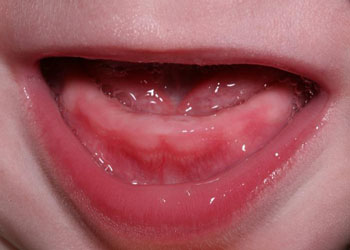 температура при прорезывании зубов комаровский