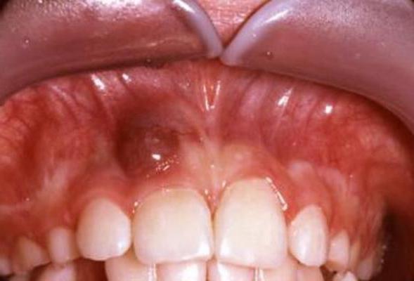 гранулема зуба лечение в домашних условиях 