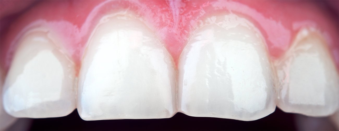 Фото здоровой эмали зубов