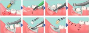 Что делать после удаления коренного зуба, сколько заживает лунка и как осуществлять уход за полостью рта: рекомендации