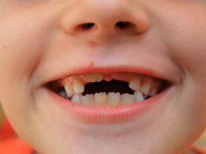 Когда начинают выпадать зубы у детей: схема, сроки и порядок смены молочных единиц на постоянные с таблицей