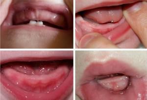 Как выглядят набухшие десна ребенка в период прорезывания первых зубов: симптомы у грудничка с фото