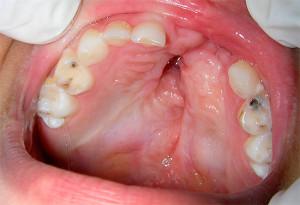 Как лечить пульпит молочных зубов у ребенка, возможно ли лечение в одно посещение стоматолога?