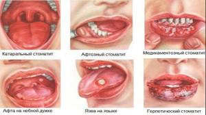 Болячки и язвы на слизистой рта у взрослых: фото, причины появления и лечение ранок в домашних условиях