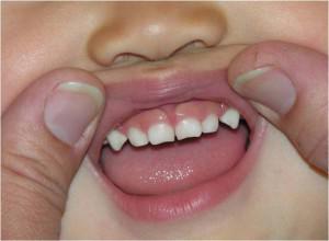 Какие зубы человека называются резцами и клыками: фото центральных и боковых единиц