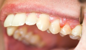 Симптомы воспаления корня зуба: что делать и как лечить в домашних условиях?