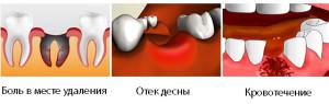 Что делать после удаления коренного зуба, сколько заживает лунка и как осуществлять уход за полостью рта: рекомендации