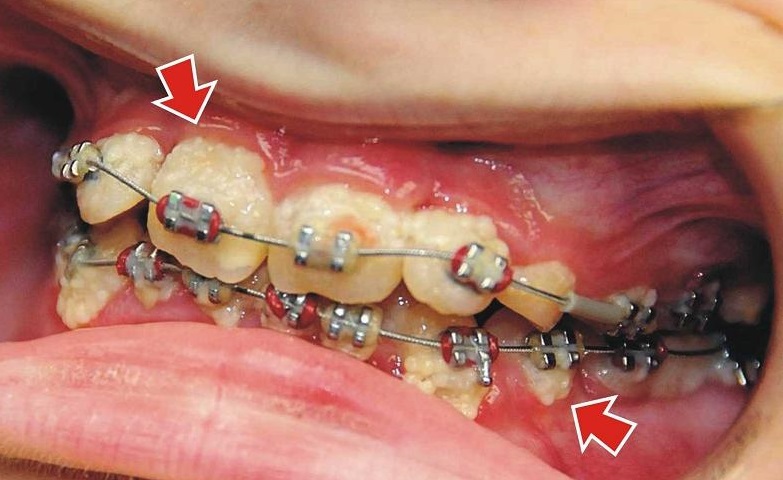 Брекеты способствуют скоплению налета, то есть значительно снижается гигиеничность. А это приводит к разрушению зубов.