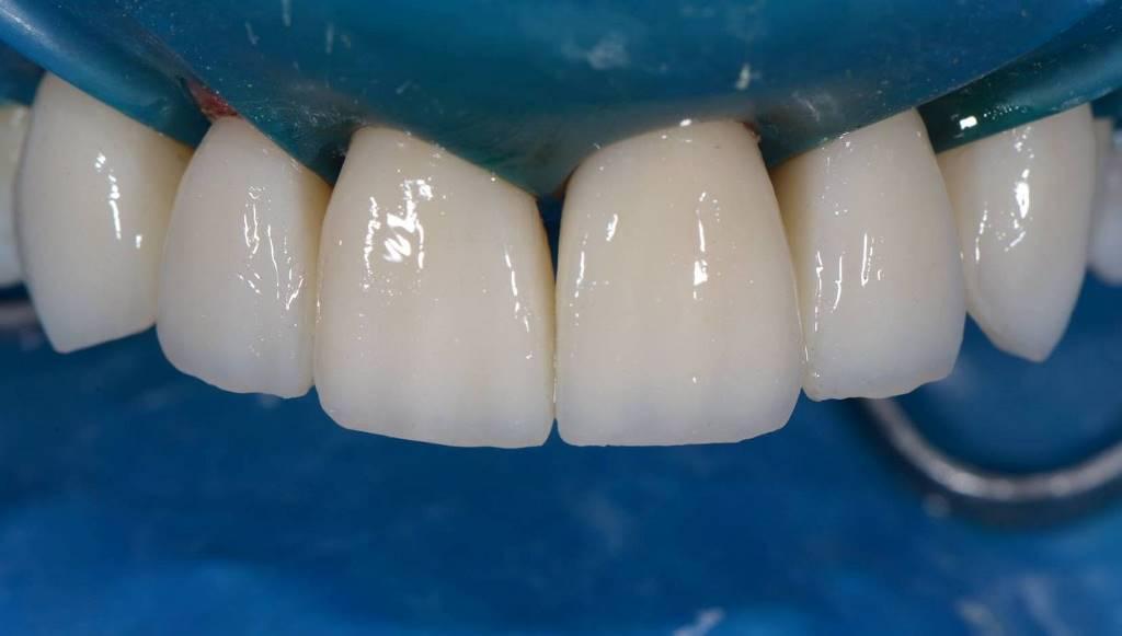 Зубная реставрация. Восстановление зуба композитом. Восстановление передних зубов. Восстановление зубов композитными материалами. Восстановление зубов винирами.